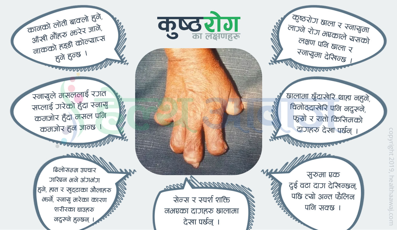 मधेशमा कुष्टरोगका बिरामीहरुको संख्या अत्यधिक